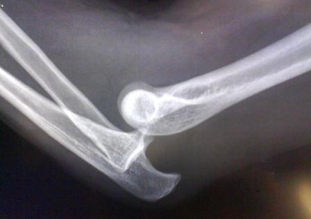 Dislocated Elbow X-ray